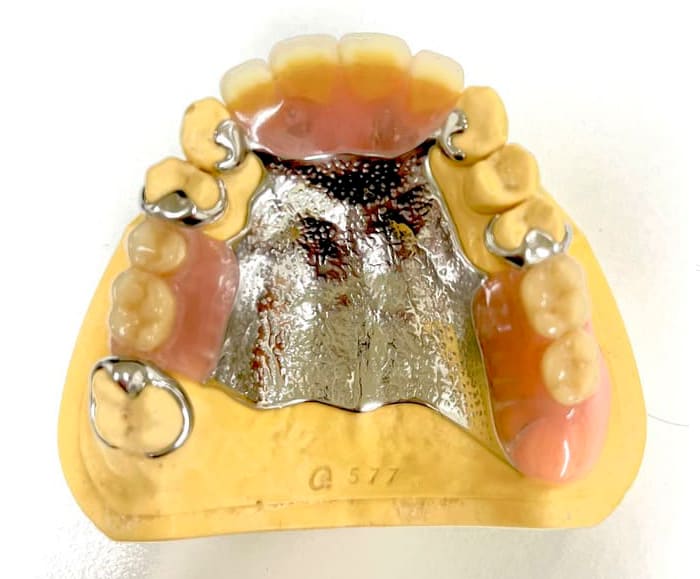 自費診療の義歯:金属床