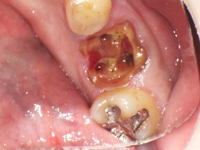 臼歯のインプラント