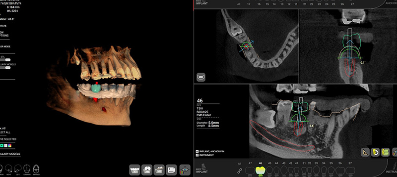 2：精密検査 歯型や歯並びの写真、歯のレントゲン、CT撮影スキャンなど精密検査を行ないます。